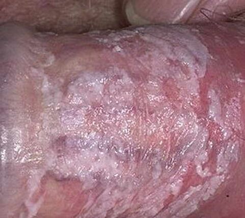 curdled discharge when excited